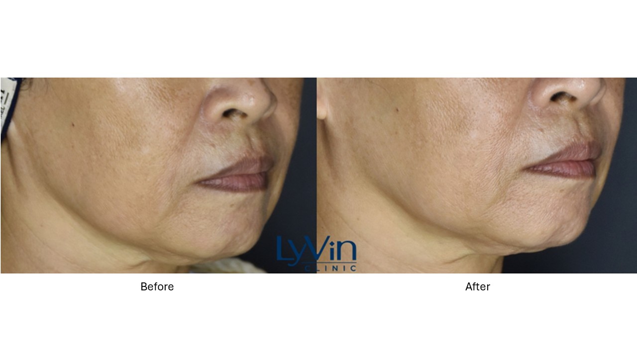 Skin rejuvenation results with Juvelook injectable – before and after Skin rejuvenation results with Juvelook injectable – before and after